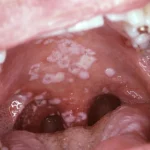 Oral Thrush: Causes, Symptoms, Diagnosis & Treatment Options