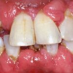 Periodontal Disease: Causes, Symptoms, Diagnosis and Treatment Options