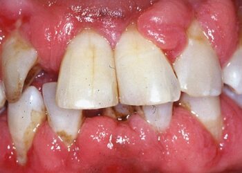 Periodontal Disease: Causes, Symptoms, Diagnosis and Treatment Options