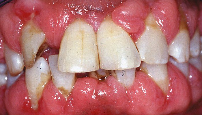 Periodontal Disease: Causes, Symptoms, Diagnosis and Treatment Options