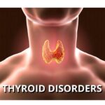 Thyroid Disorders: Symptoms, Causes, Diagnosis & Treatment Options
