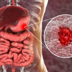 Ulcerative Colitis Diet Plan: What to Eat During a Flare and Remission