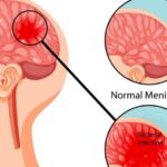 Meningitis: Causes, Symptoms, Diagnosis & Treatment Options