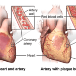 Angina: Causes, Symptoms, and Treatment Explained