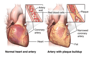 This illustration shows how plaque buildup in coronary arteries leads to reduced blood flow, a key cause of angina.