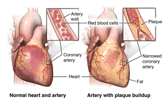 This illustration shows how plaque buildup in coronary arteries leads to reduced blood flow, a key cause of angina.