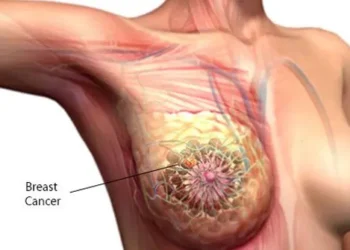 Breast Cancer Symptoms, Screening, and Treatment: A Complete Guide