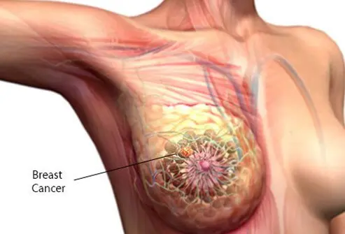 Breast Cancer Symptoms, Screening, and Treatment: A Complete Guide