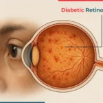 Diabetic Retinopathy: Causes, Symptoms, Diagnosis & Treatment Options