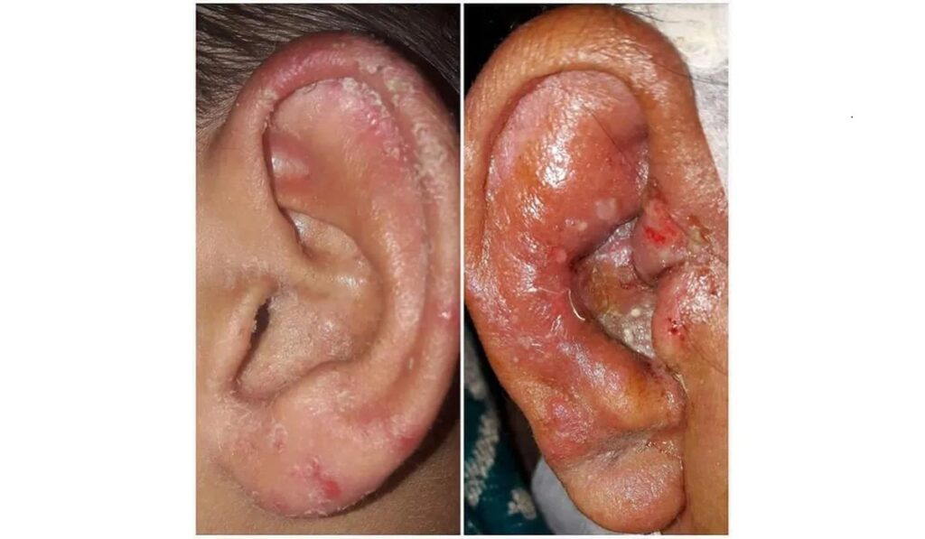 Ear Infections: Causes, Symptoms, Diagnosis & Treatment Options