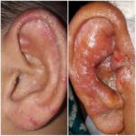 Ear Infections: Causes, Symptoms, Diagnosis & Treatment Options