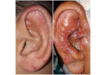 Ear Infections: Causes, Symptoms, Diagnosis & Treatment Options