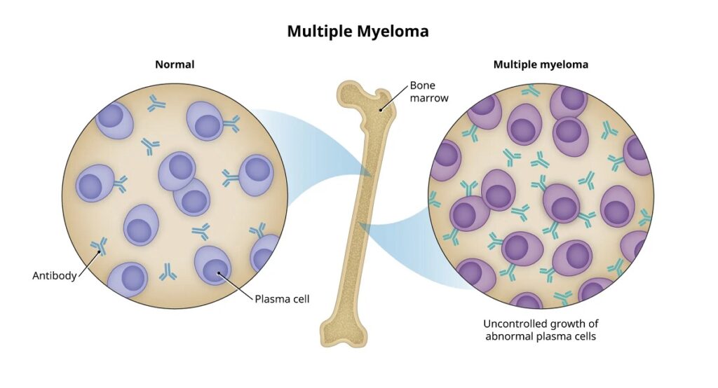 Multiple Myeloma: Causes, Symptoms, Diagnosis & Treatment Options