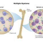 Multiple Myeloma: Causes, Symptoms, Diagnosis & Treatment Options