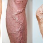 Thrombosis: Symptoms, Causes, Types, and Treatment