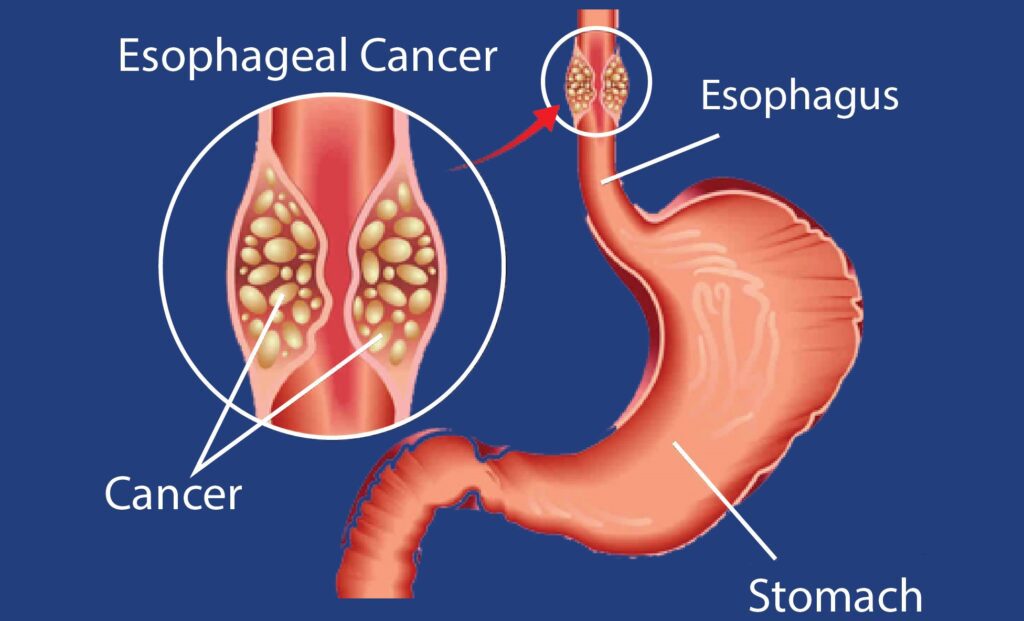 Esophageal Cancer: Symptoms, Causes, Diagnosis, and Treatment