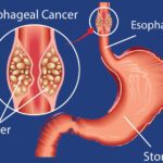 Esophageal Cancer: Symptoms, Causes, Diagnosis, and Treatment