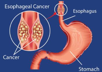 Esophageal Cancer: Symptoms, Causes, Diagnosis, and Treatment