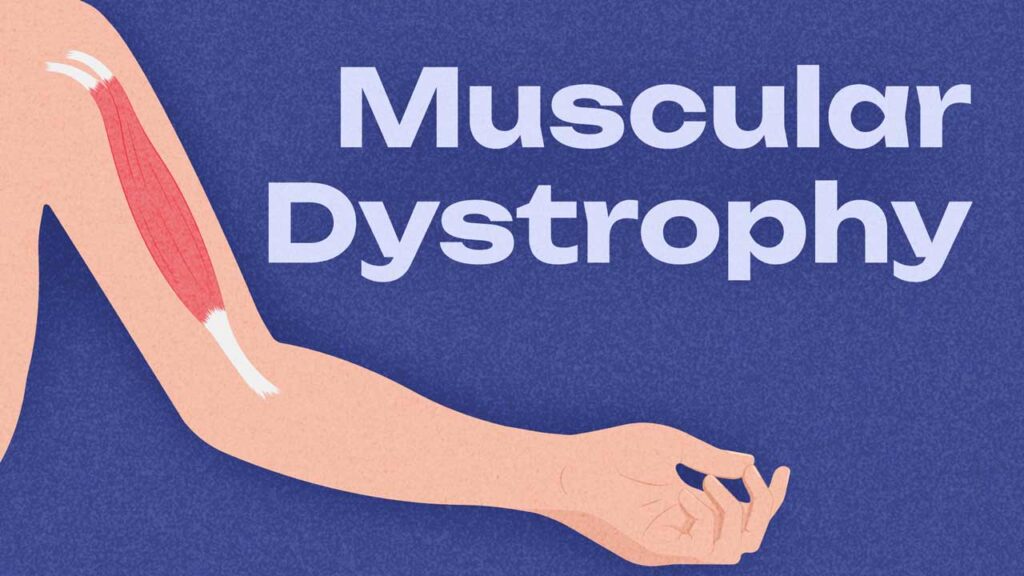 What Is Muscular Dystrophy? Causes, Types & Treatment Advancements