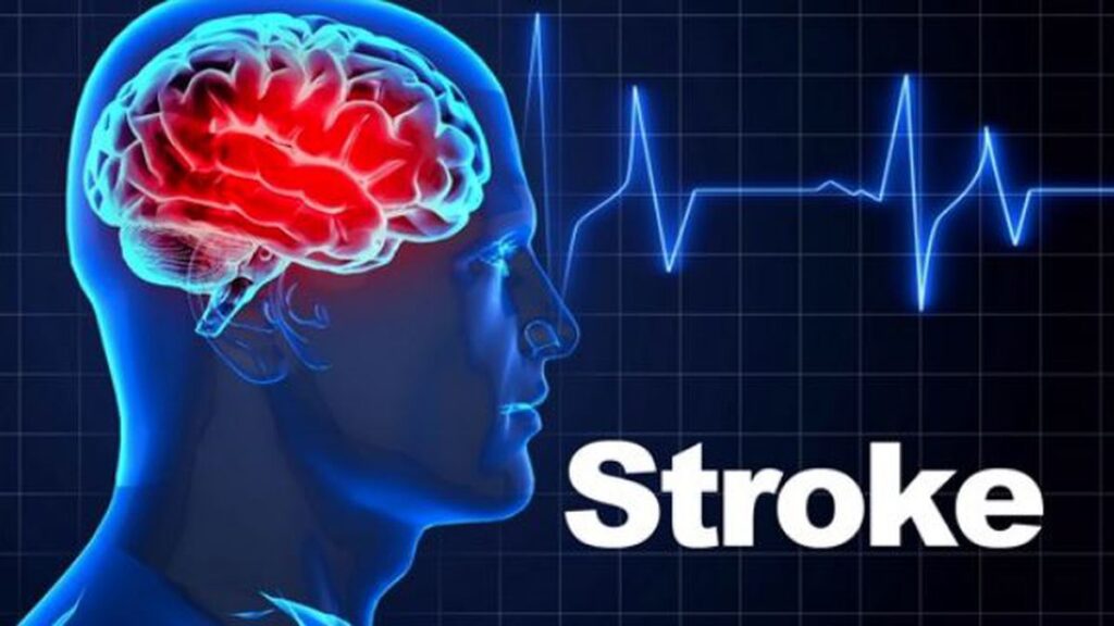 Stroke: Causes, Symptoms, Diagnosis, and Treatment Options