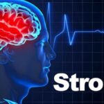 Stroke: Causes, Symptoms, Diagnosis, and Treatment Options