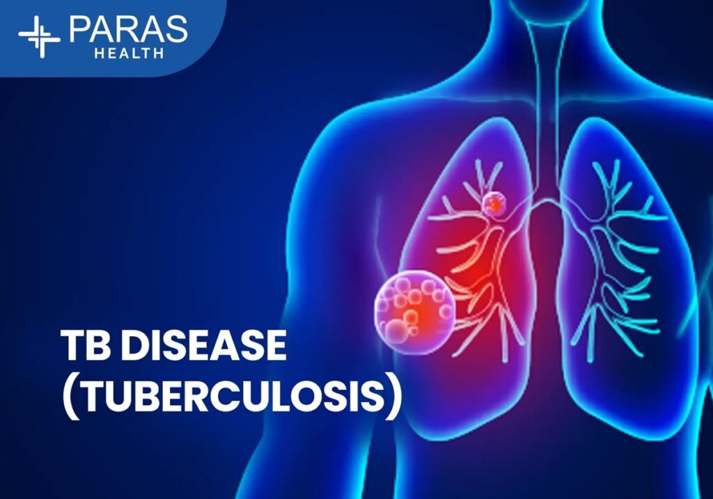 Tuberculosis (TB): Symptoms, Diagnosis, and Treatment