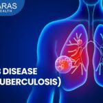 Tuberculosis (TB): Symptoms, Diagnosis, and Treatment